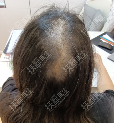 產後脫髮 Before